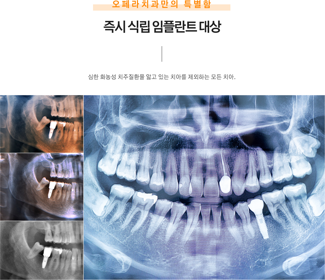 즉시 식립 임플란트 대상
심한 화농성 치주질환을 앓고 있는 치아를 제외하는 모든 치아.
